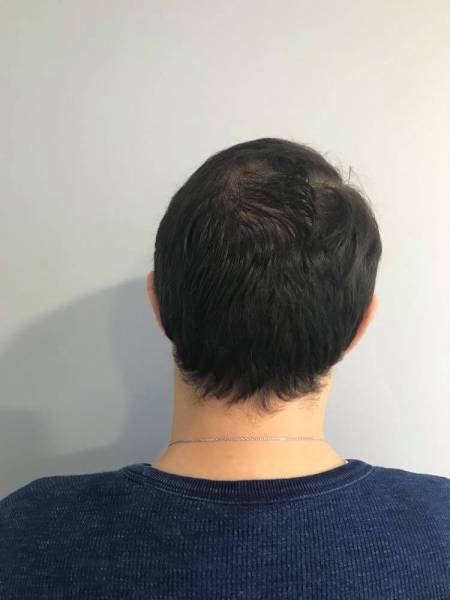 comment corriger un début de calvitie sans passer par des implants aux alentours d'Avignon