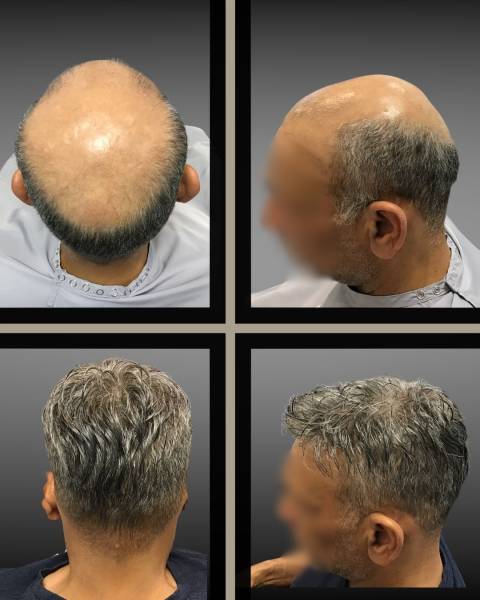 Pose de complément capillaire Hairskeen pour homme dans le Gard