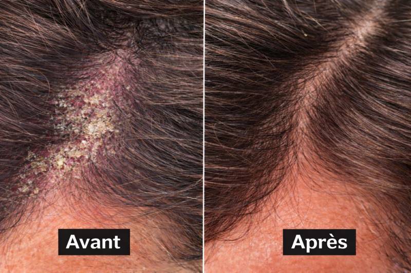 Traitement du dermatite séborrhéique vers Avignon