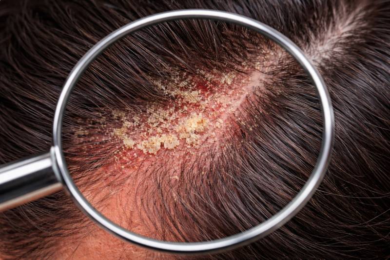 Dermatite séborrhéique du cuir chevelu